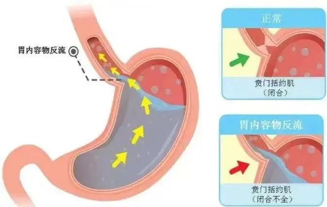 食管裂孔疝，有哪些症状？