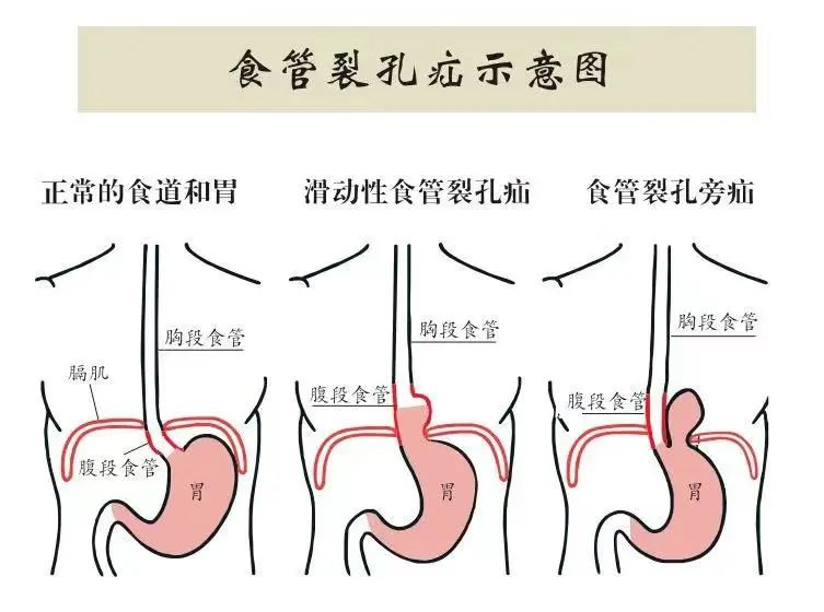 什么是食管裂孔疝呢？