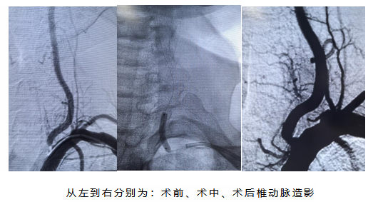 西北首例丨新疆医科大学第二附属医院神经介入团队成功开展椎动脉紫杉醇涂层球囊临床应用